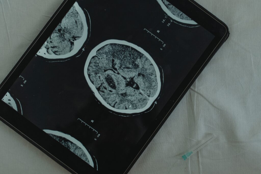 Brain image representing methods of diagnosing brain injury in personal injury cases