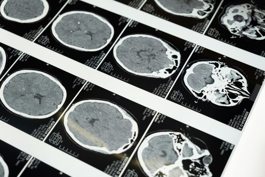 MRI images of the brain representing brain injury awareness month